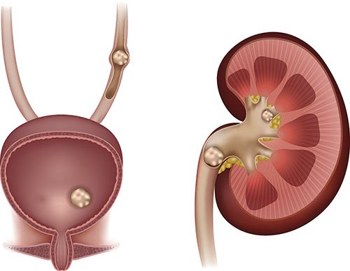 Kidney Stones Formation